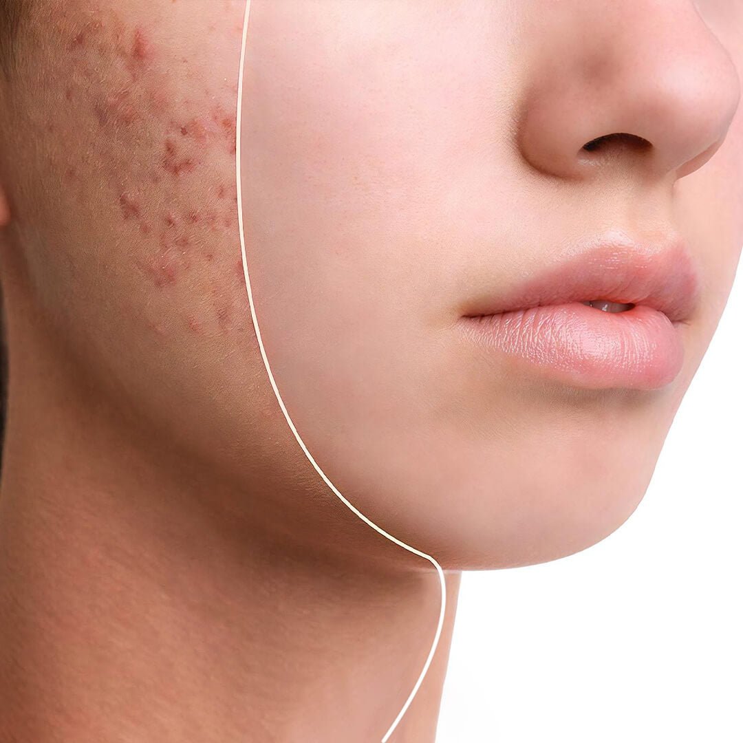 What Causes Hormonal Acne? - Skin Chemistry Official