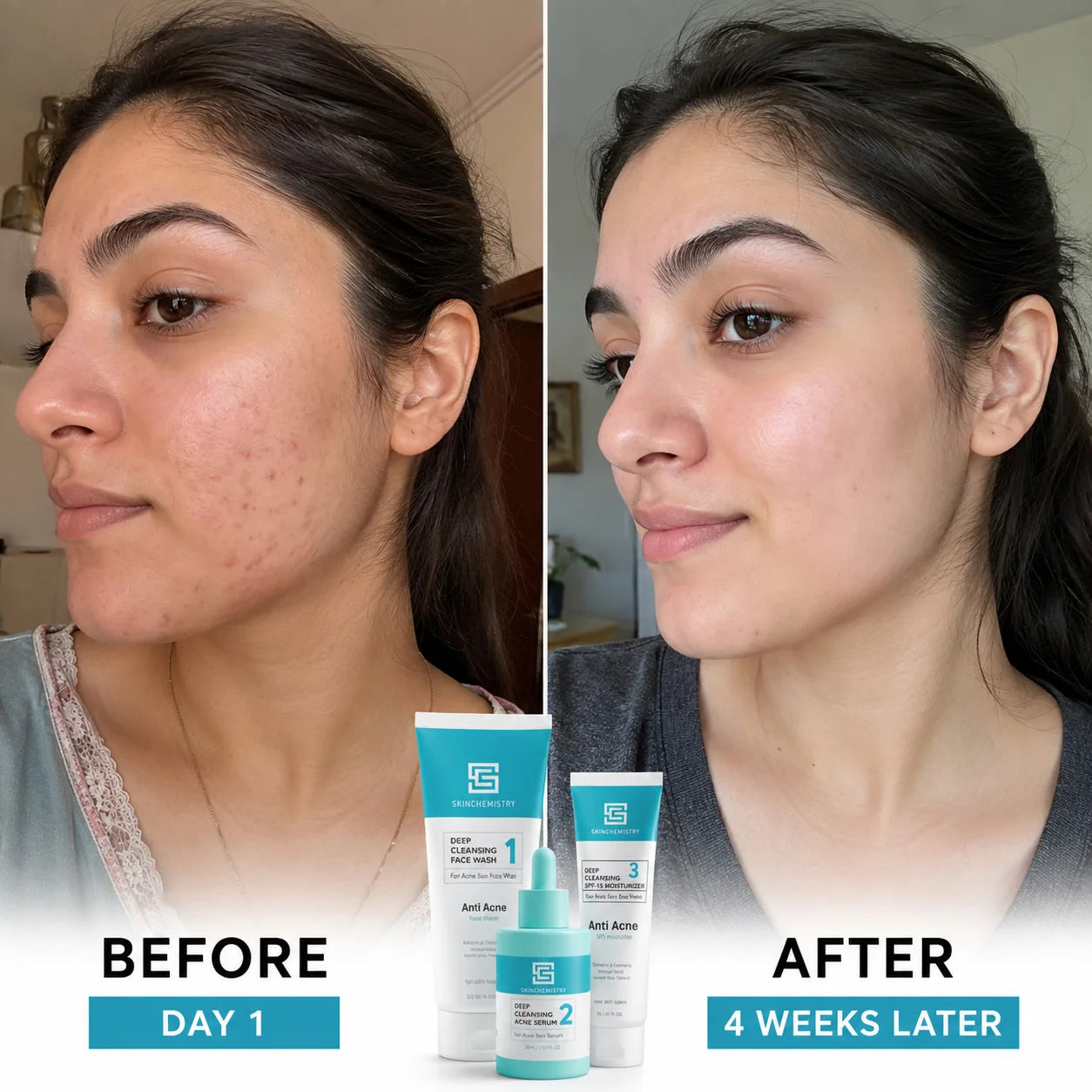 Acne Scar Removal Bundle